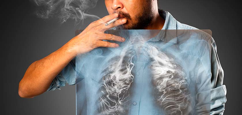 рентген легких мужчины во время курения